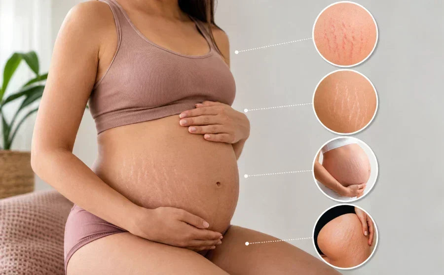 Types of Stretch Marks: What Your Skin Is Telling You (And What To Do About It)