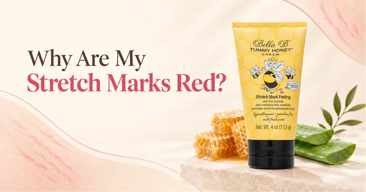 Red Marks on Stretch Marks: Why Are My Stretch Marks Red?