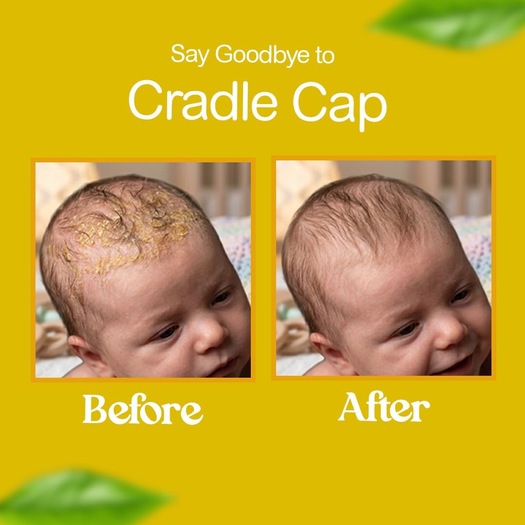 Before and after comparison of cradle cap on a baby's head with a yellow background.